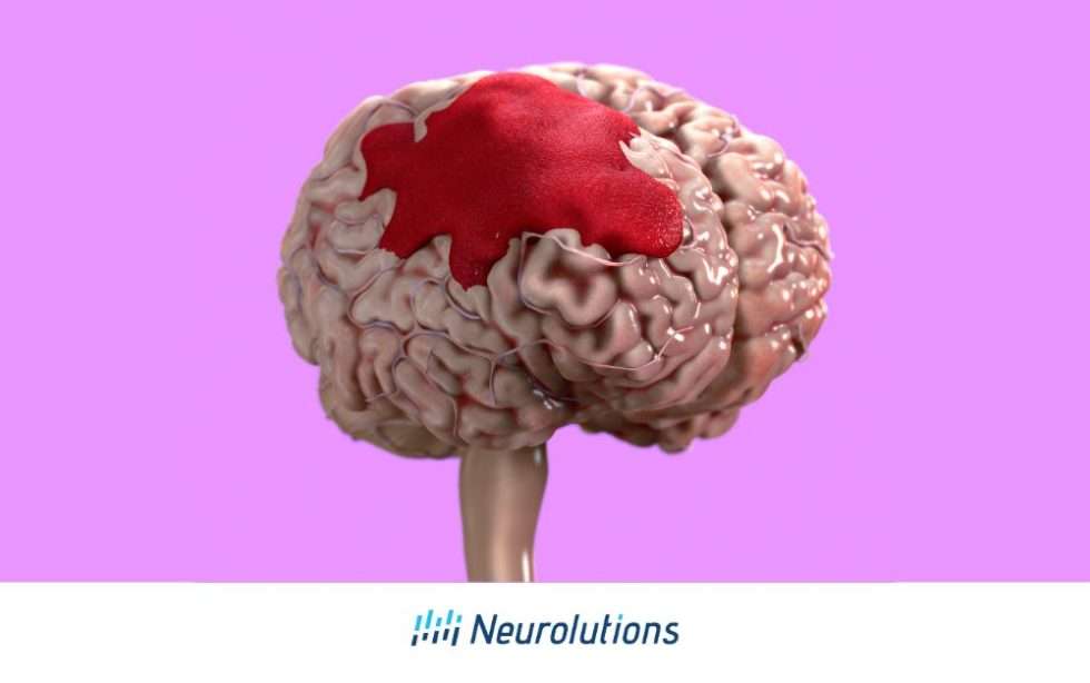 Brain Bleed vs Stroke - Neurolutions